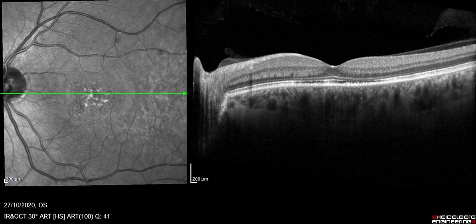 Central serous chorioretinopathy (CSR) Post PDT