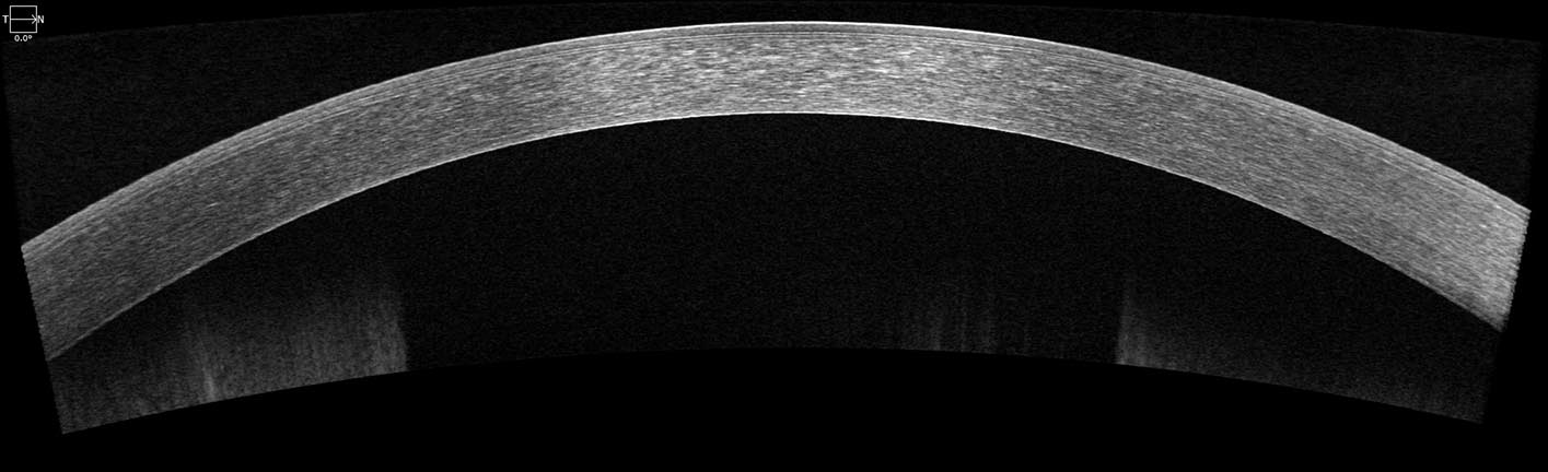 Cornea OCT Normal