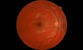 Right Retina
