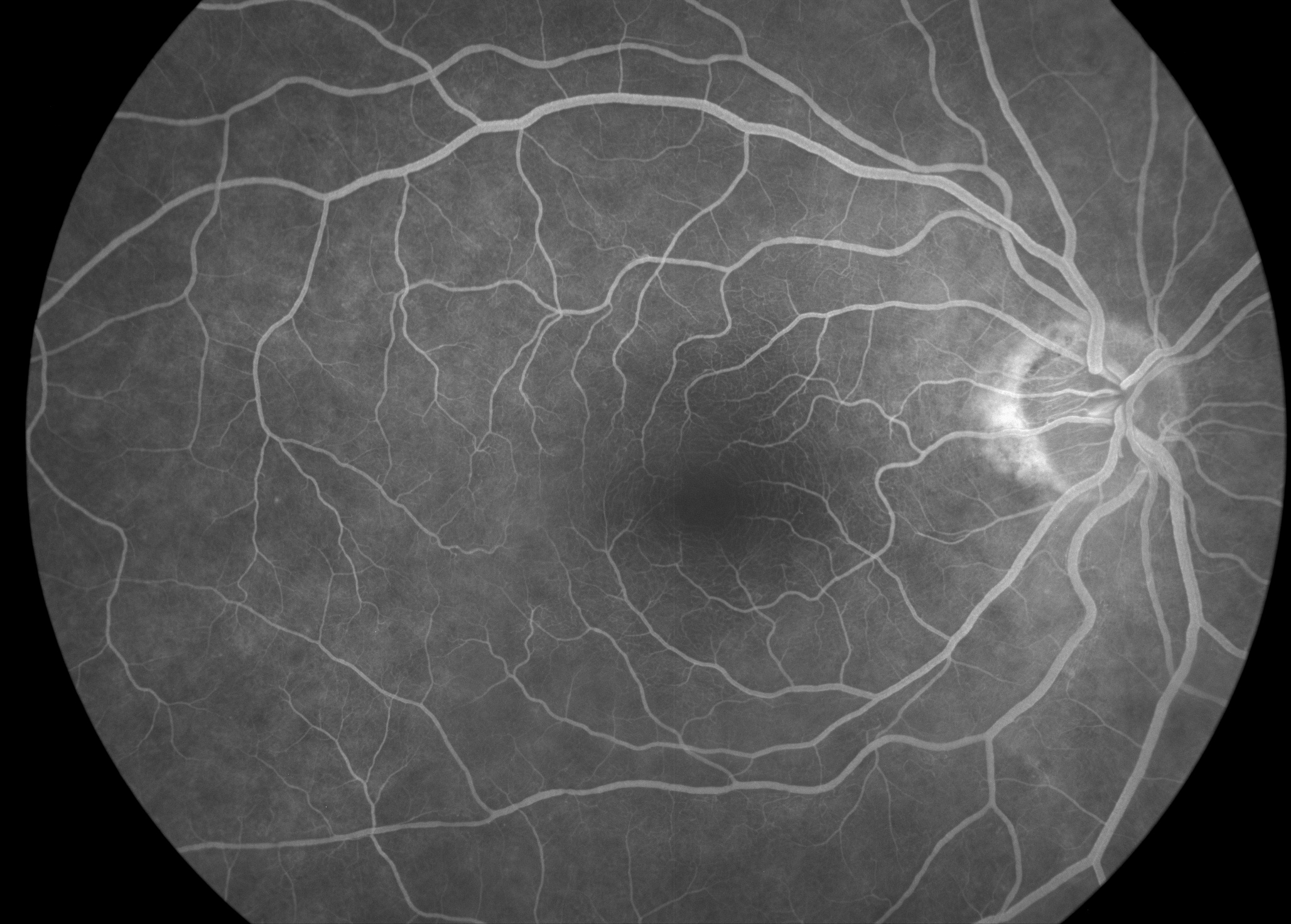 Right eye