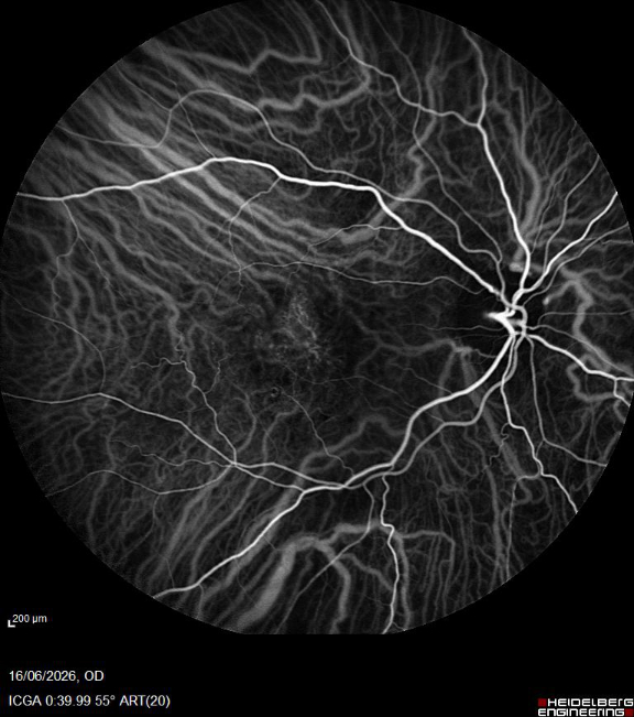 Age Related Macular Degeneration RE ICG