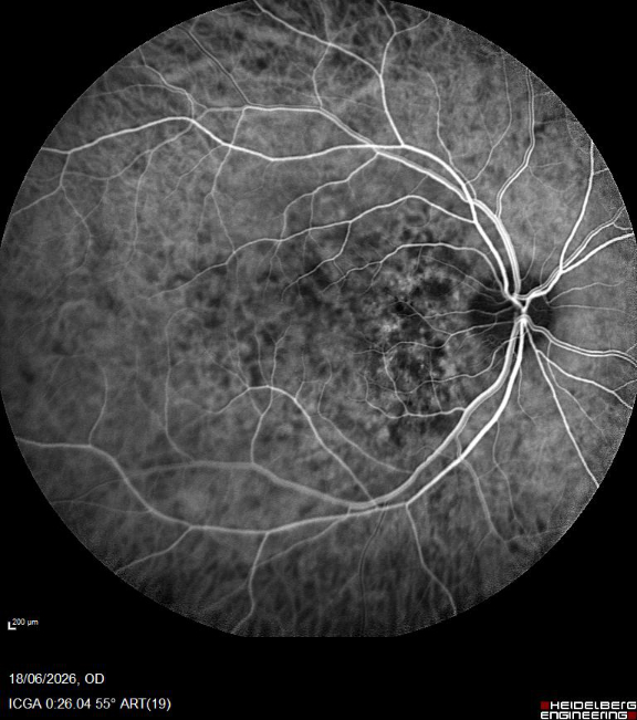 Choroidal Hemangioma Optic Nerve
