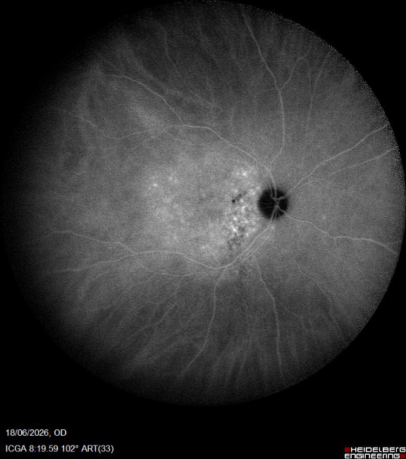 Choroidal Hemangioma Widefield