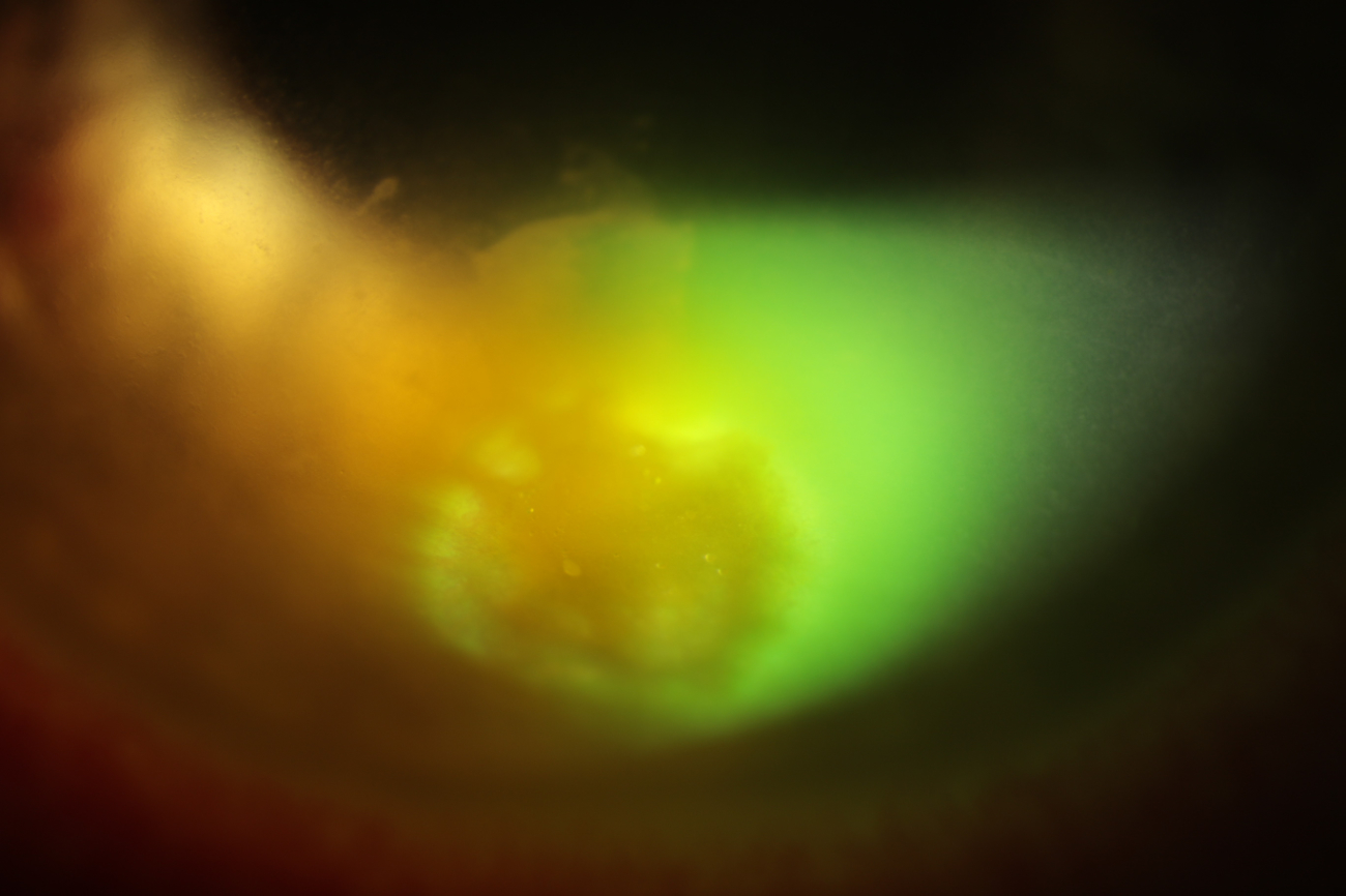 Infection of the cornea. Eye infections can be common but also can very serious. They can be caused by forging bodies entering the cornea via multiple pathways including contact lenses. In serious cases of eye infections patients may require a corneal graft / transplant