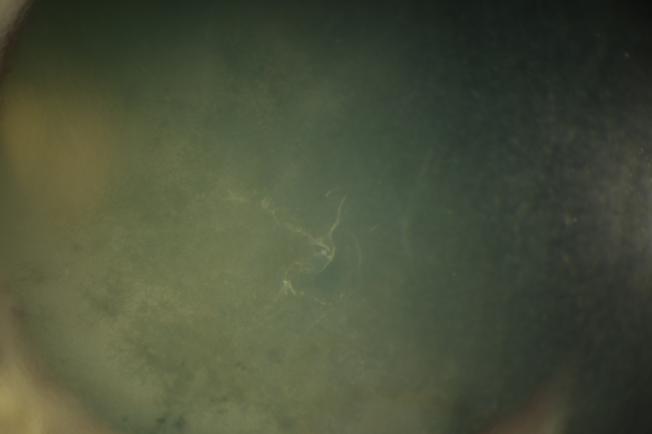 Fuchs Dystrophy of the cornea - fluid can accumulate within the cornea, causing it to become cloudy and resulting in blurred vision and increased sensitivity to light.