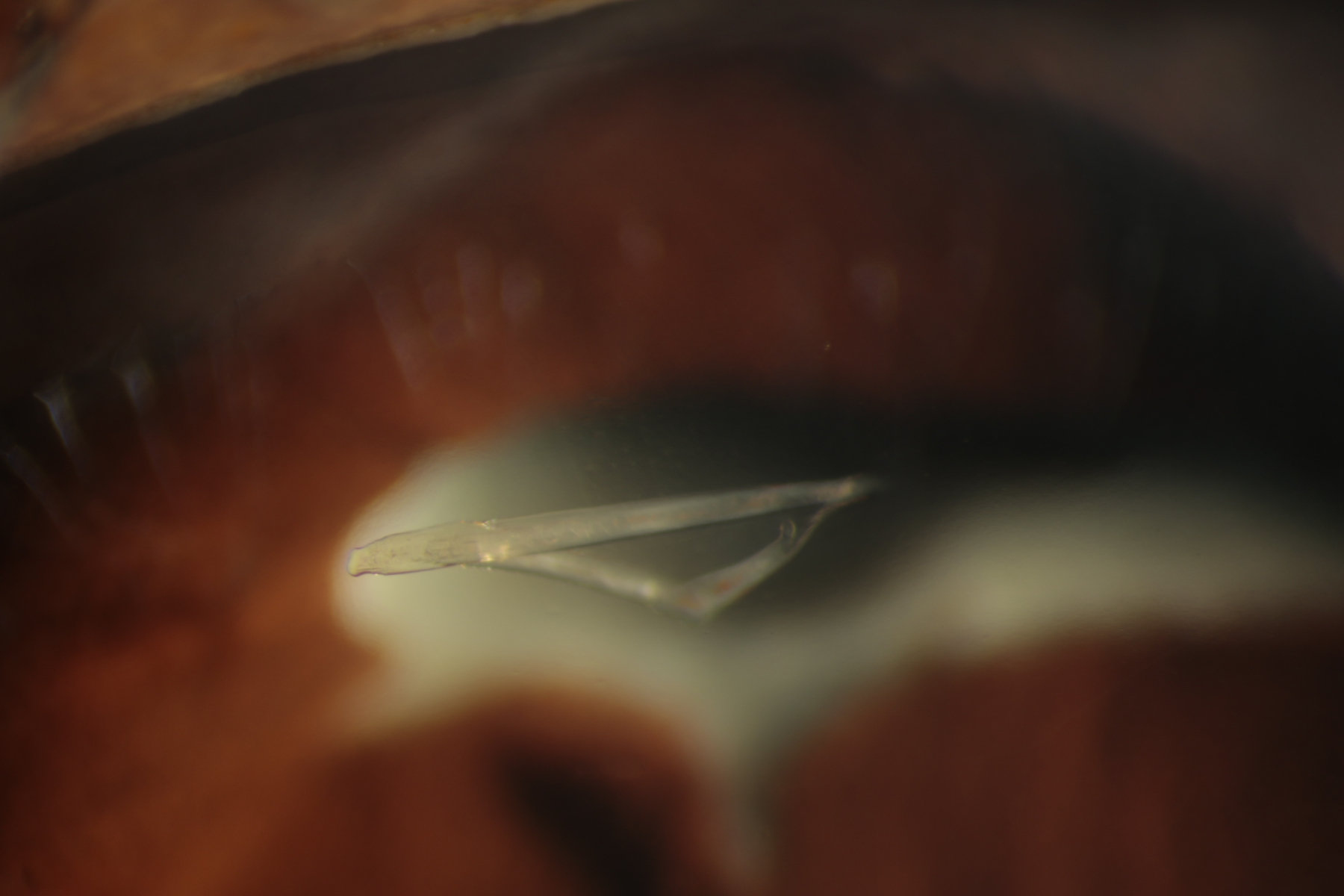 Glass fragment in cornea. Trauma to the front of they eye is quite common and illustrates the need to wear protective eye wear when available