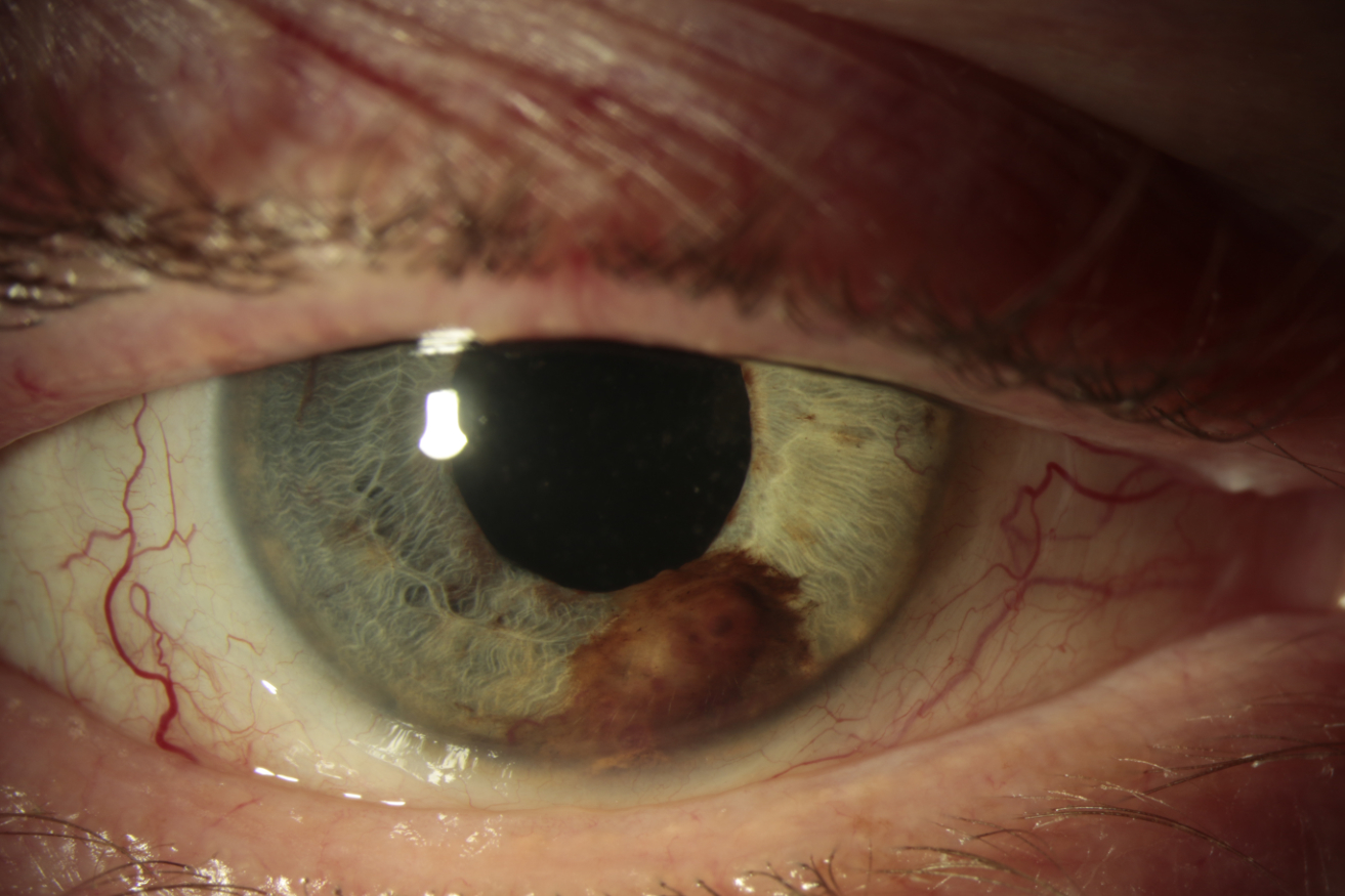 Iris tumors are defined as abnormal growths that occur in the iris, which can be benign or malignant and are managed through our hospitals oncology service.
